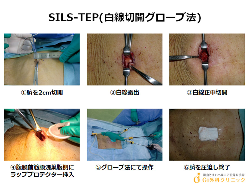 SILS-TEP(白線切開グローブ法)