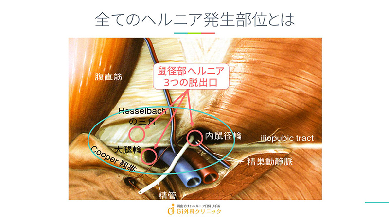 大腿ヘルニアの重度の症状